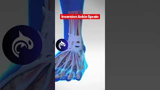 See the difference between both Eversion and Inversion Ankle Sprains in 3D Animation [upl. by Odnomyar]