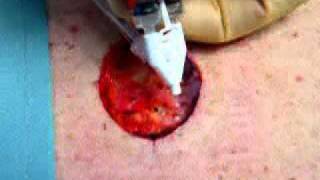 Fibrin Spray to Aid in Wound Healing [upl. by Atileda397]