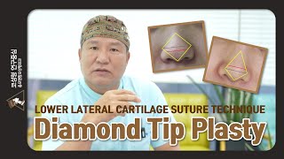 다이아몬드 코끝교정술 코끝올리기 무보형물 돼지코성형 diamond tipplasty tip projection no strut soft nasal tip [upl. by Hsihsa]