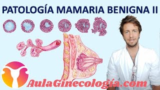 PATOLOGÍA BENIGNA DE LA MAMA II FIBROADENOMA PAPILOMA HIPERPLASIA  Ginecología y obstetricia [upl. by Ynohtona527]