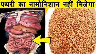 कुल्थी की दाल पथरी का काल फायदे इतने जो उंगलियों पर गिने नहीं जा सकतेkulthi ki daal ke fayde [upl. by Bradman]