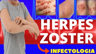 HERPES ZOSTER  O QUE É SINTOMAS DIAGNÓSTICO E TRATAMENTO  VARICELA ZOSTER  INFECTOLOGIA [upl. by Claudy]