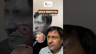 Mole Removal in Just 1 Session Is Now Possible  Dr Deepam Shah [upl. by Atinihs]