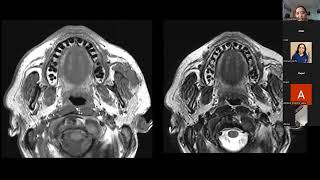 Radiological anatomy of Salivary glands  Dr Vasundhara Patil [upl. by Sima470]