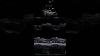 Ejection Fraction By M mode echo cardiography echocardiography [upl. by Babette]