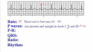 ECG Normal Sinus Rhythm NSR [upl. by Yasmine]