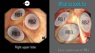 Mastering Bronchoscopy for Thoracic Surgery Chapter 2 [upl. by Yerg]