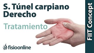 Tratamiento del síndrome de túnel carpiano derecho [upl. by Petulah]