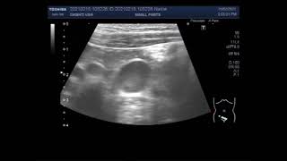 Mesenteric lymphadenitis [upl. by Etaner]