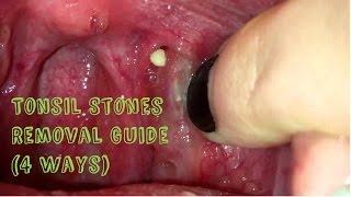 How to Remove Tonsil Stones Tonsillitis at Home [upl. by Ahsitan965]