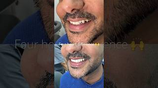 Composite bonding by Dr Josh 🙌 compositebonding smilemakeover [upl. by Nonnarb493]