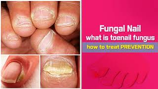 Nail Nail Health Tips Best Home Remedy Cure for Toenail Fungus  Health tips [upl. by Adnamal]