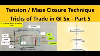 MassTension Closure Technique For Laparotomy Closure Trailer Tricks of Trade in GISx Part 58 [upl. by Britton]