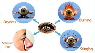 Dry Eye  Clinical Features and Investigation Within 300 Mins 34 [upl. by Shaver]