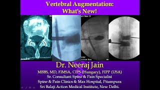 VERTEBROPLASTY CEMENT AUGMENTATION WHATS NEW Dr Neeraj Jain MBBS MD FIMSA CIPS FIPPUSA [upl. by Oregolac]