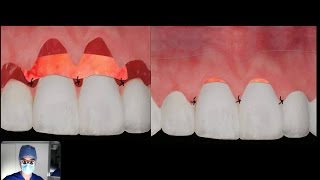 How does a CONNECTIVE TISSUE graft work [upl. by Endaira]