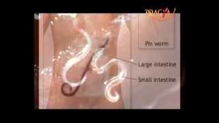 Stomach Worm in Kids  DrSapna Bhardwaj Tell what is the symptoms and how to solve [upl. by Airdnat209]