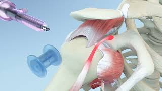 Torn Rotator Cuff Causes Symptoms amp Treatment  DePuy Videos [upl. by Feenah787]