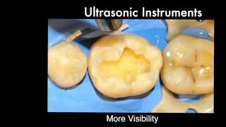 Finishing of Cavity Margins for Direct Posterior Resin Composite Restorations [upl. by Reggis]