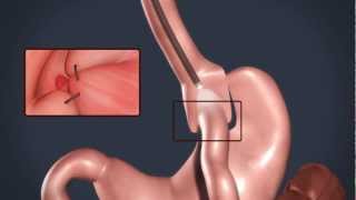 Overstitch Procedure [upl. by Arlette]