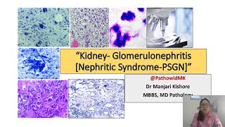 Glomerulonephritis 1 Nephritic Syndrome PSGN [upl. by Graeme520]