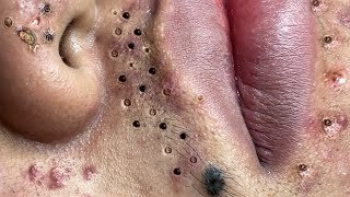 Blackhead Removal With Sac Dep Spa 1000319 [upl. by Atinreb218]