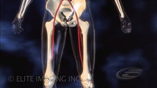 Femoral Clot Removal  Medical amp Scientific Video Production [upl. by Tran]