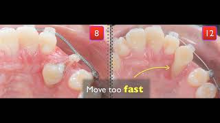 Treatment of palatal impaction [upl. by Adelaide]