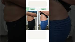 Laser slimming treatment at Indian Skin Clinic 👩‍⚕️ [upl. by Hendrix]