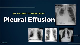 Pleural Effusion  Types Causes Evaluation amp Management All You Need To Know For Exam [upl. by Phelips920]