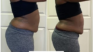 My Laser Lipo Experience  before and after results  🔥🔥 [upl. by Li]