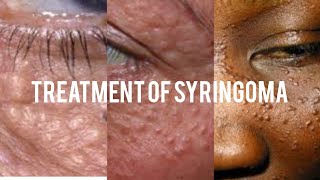 Treatment of syringoma [upl. by Llenroc]