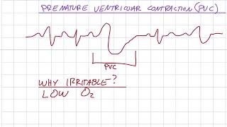 EKG 310  Premature Ventricular Contraction PVC [upl. by Ydnas12]