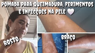 Pomada para queimadura ferimentos e infecções na pele Passando no meu rosto🤍 braço [upl. by Palgrave]