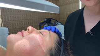 Extractions  Facial Treatment  West Hollywood CA  Dr Jason Emer [upl. by Analram]