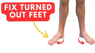 Fix TURNED OUT Feet with Two Easy Exercises duck feet [upl. by Press148]