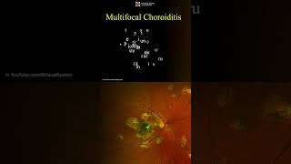 Multifocal Choroiditis Symptoms and Treatment ophthalmology optometry [upl. by Anileda]