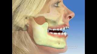 TMJ  Temporomandibular joint dysfunction [upl. by Adnofal493]