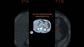 Acute necrotizing pancreatitis [upl. by Annaor392]