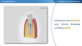 Ablauf der Behandlung  Wurzelspitzenresektion [upl. by Sheela]