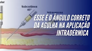 Esse é o ângulo correto da agulha na aplicação intradérmica [upl. by Antipas]