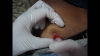 How To Give An IM Injection At Buttocks amp Choose Site For Injection [upl. by Orren]