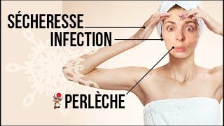 MES ASTUCES POUR SOIGNER LES PETITS BOBOS DHIVER PERLECHE SECHERESSE [upl. by Innad875]