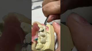 Denture fitting viralvideo dentistryworld viralshortvideo dentist dental dentalclinic [upl. by Rashida943]