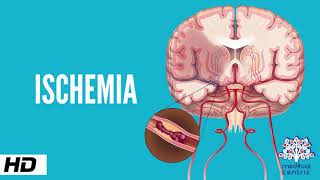 Ischemia Causes Signs and Symptoms Diagnosis and Treatment [upl. by Ardnassela]