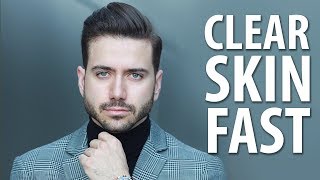 HOW TO GET CLEAR SKIN FAST  Mens Skincare Routine  ALEX COSTA [upl. by Sada]