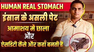 FullVideoAcidity amp Gastric Ulcer in Real Stomach  इंसान के असली पेट में ऐसिडिटी और छाले viral [upl. by Neerihs376]