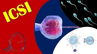 ICSI  Intracytoplasmic Sperm Injection [upl. by Ellord]