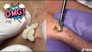 Satisfying Blackhead Removal Compilation 😍 Ultimate Skincare Satisfaction [upl. by Igig]