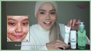 Clear Your Acne Effectively with Eucerin ProACNE Solution [upl. by Nnahgiel958]